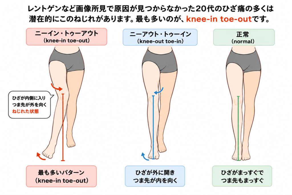 #東京ひざ痛専門整体院京四郎
#ひざ痛　ねじれ
