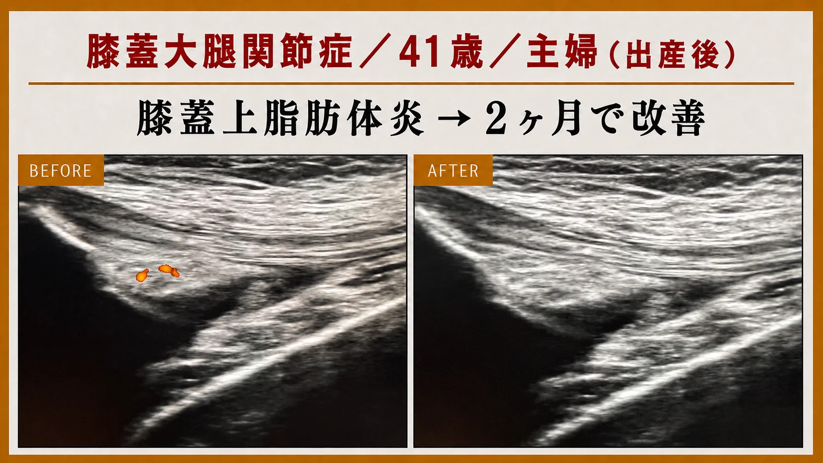 エコー画像による施術前後の経時的変化 1