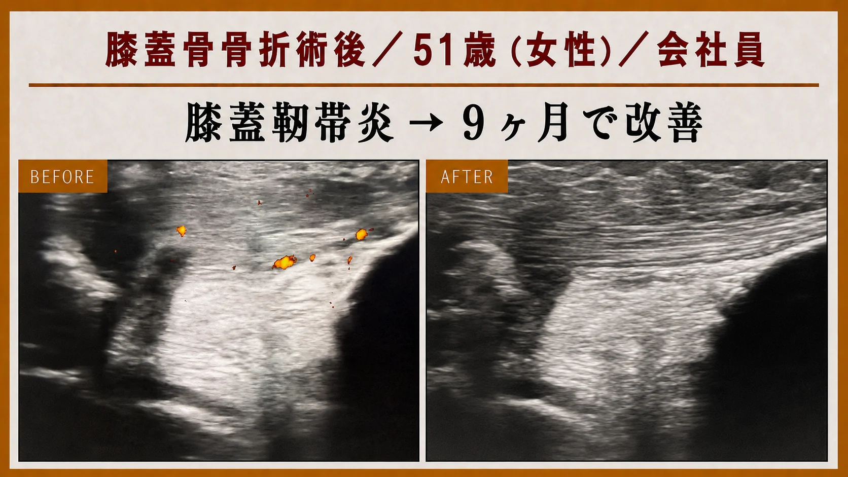 エコー画像による施術前後の経時的変化 4