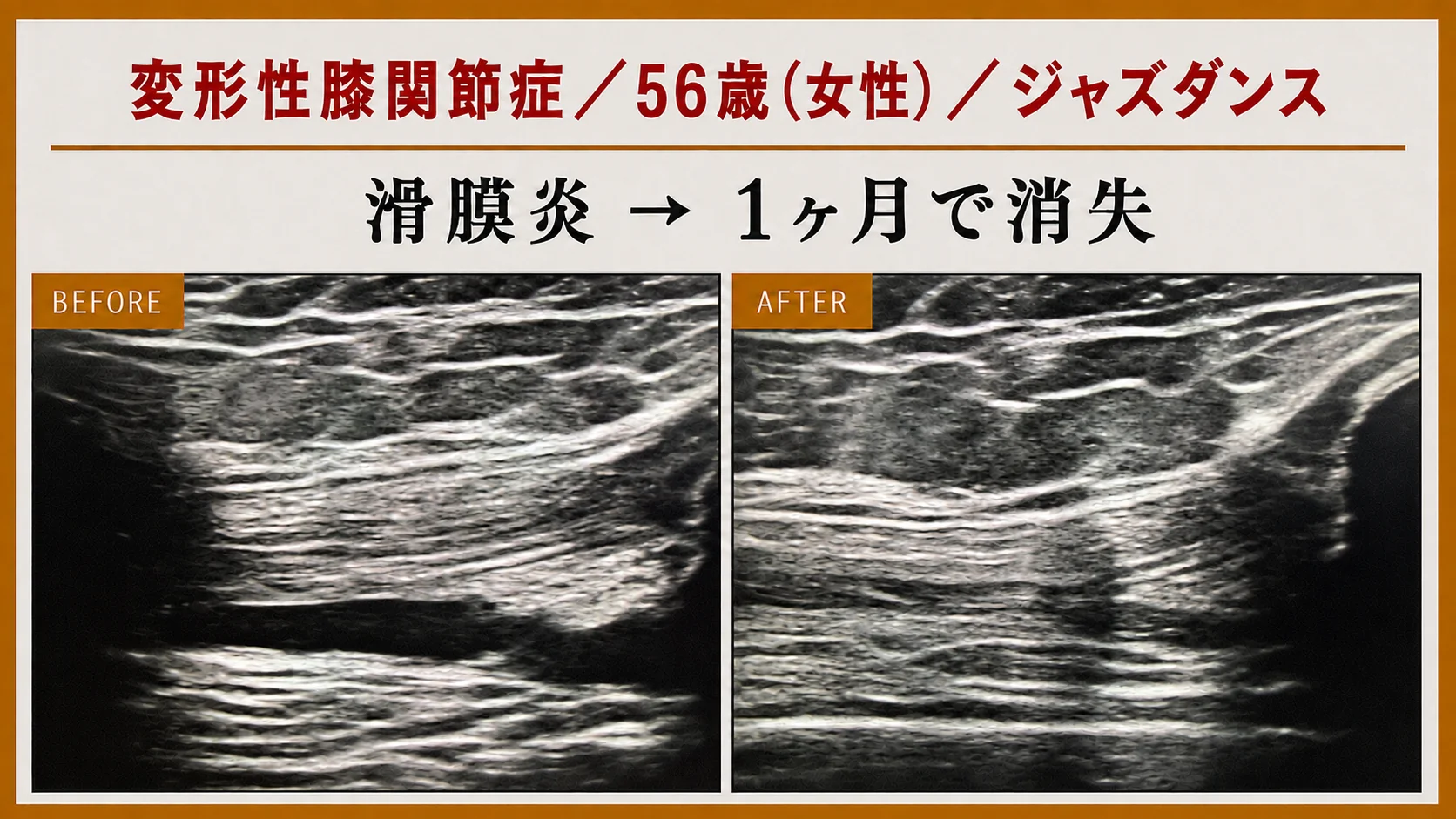 エコー画像による施術前後の経時的変化 5