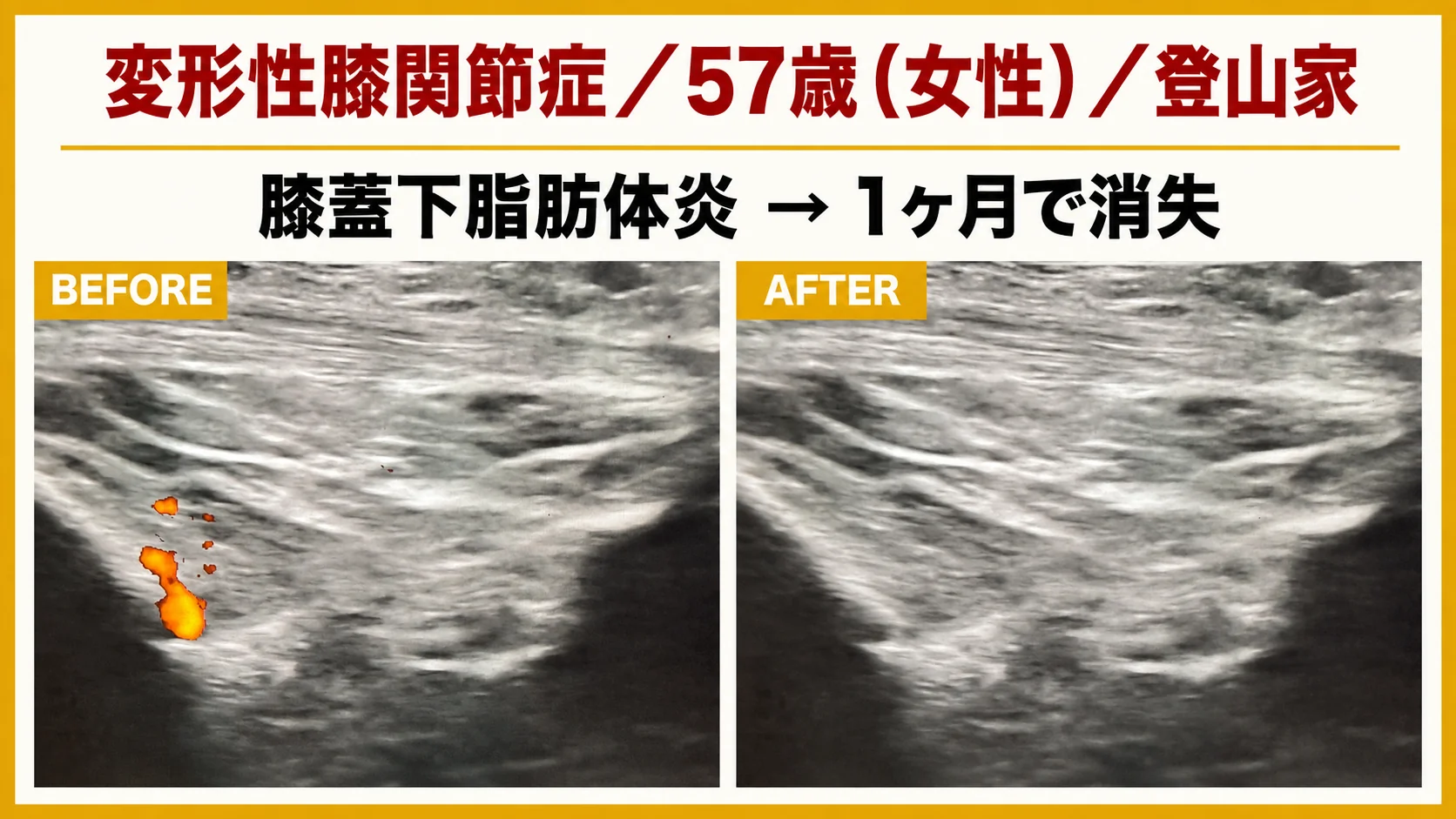 エコー画像による施術前後の経時的変化 6