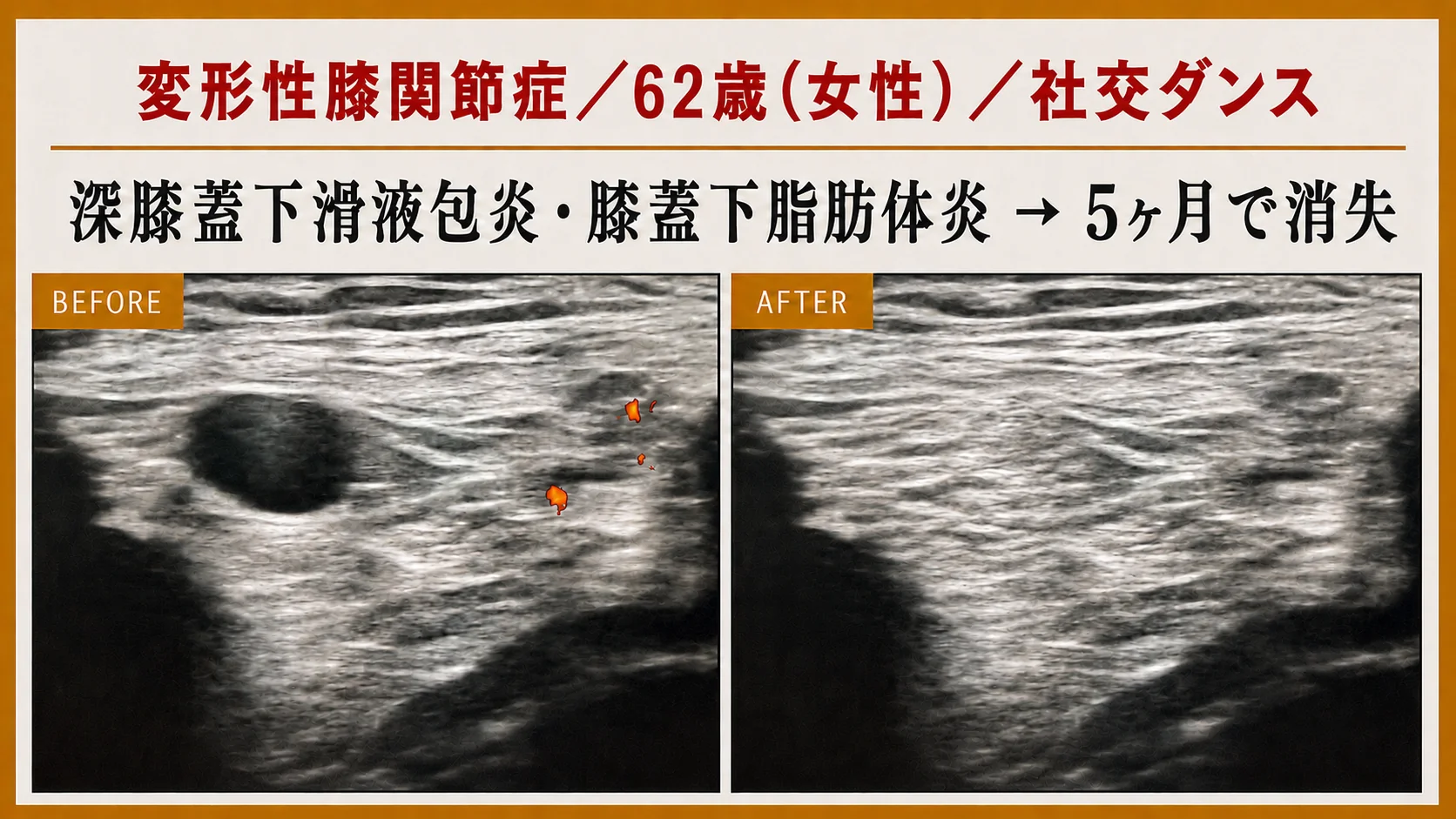 エコー画像による施術前後の経時的変化 9