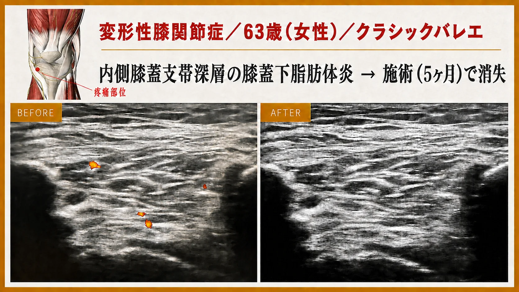 エコー画像による施術前後の経時的変化 10